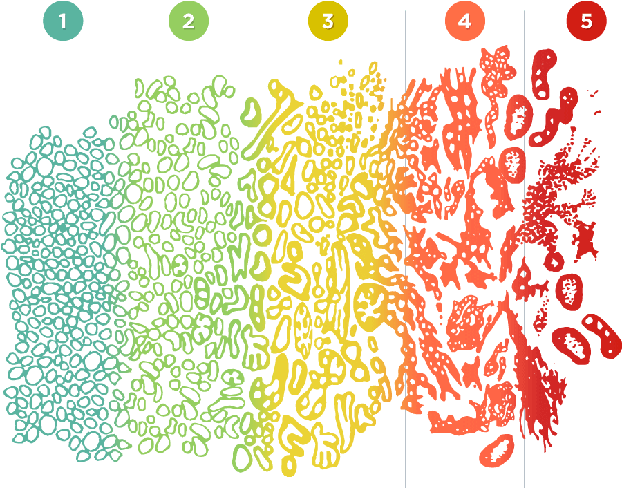 1-3-ai-based-gleason-grading-for-prostate-cancer-by-zsfvishnu-medium