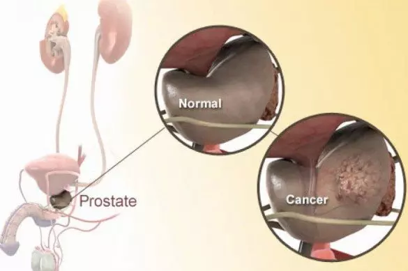 Normal vs. cancerous prostate