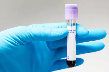 A Better Prostate Cancer Blood Test - Sperling Prostate Center