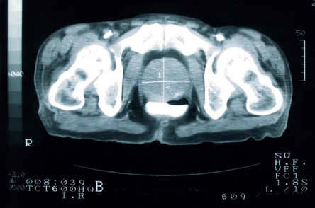 Focal Prostate Imaging