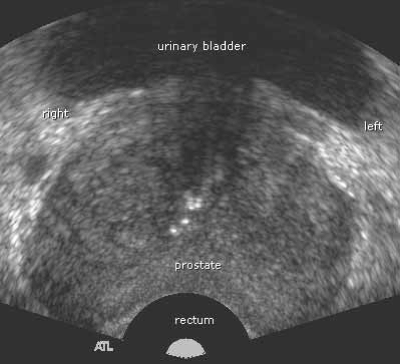 A typical TRUS transverse view of the prostate (front to back) shows the shape of the gland