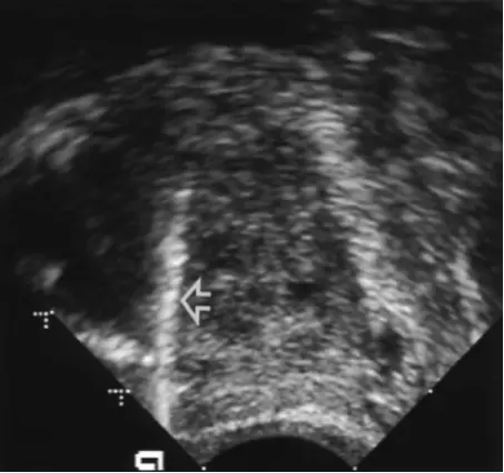 A typical TRUS sagittal view of the prostate (from the side) shows the tapered shape of the prostate. The taller end is the rear, or posterior, and the shorter end is the front tip of the prostate, or apex. The white line indicated by the arrow is a biopsy needle.