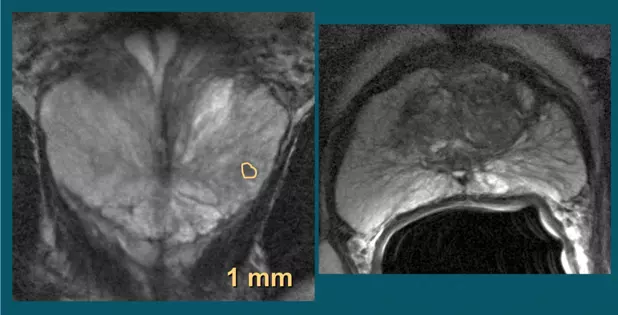 T2 weighted images show suspected tumor activity