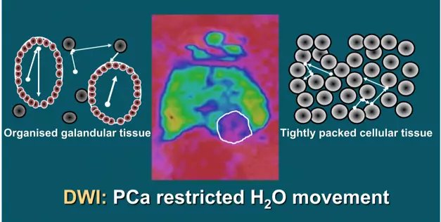 DWI images detect water molecule motion in cancerous tissue even at microscopic levels