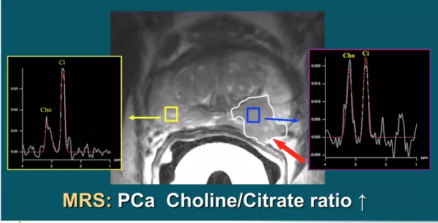 Spectroscopy improves the definition of cancer by revealing the presence of certain chemicals that indicate malignancy