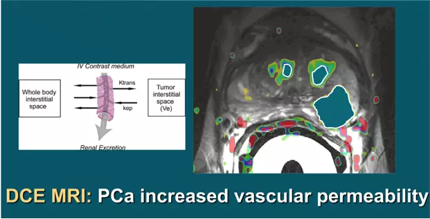 DCE shows changes in the uptake and washout of an injected contrast agent by cancer cells