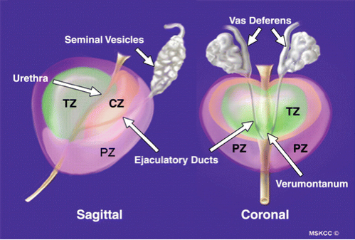 t therapy for enlarged prostate)