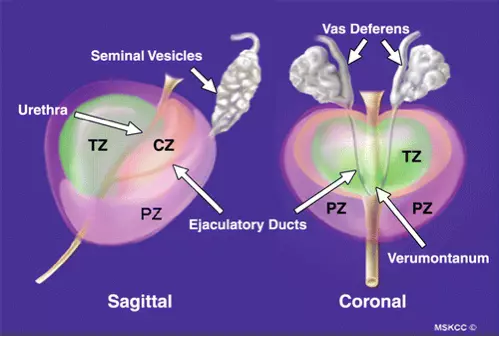 Zonal anatomy of a normal prostate gland