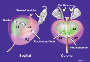 Prostate Zone Anatomy, Prostate Cancer and Imaging - Sperling Prostate ...