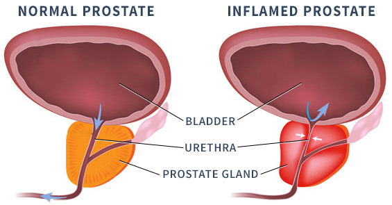 Standard a prostatitis alatt)