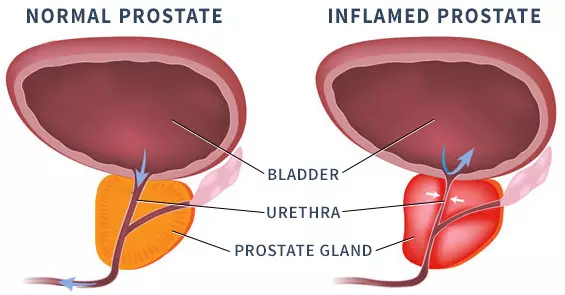 Diagnosing Prostatitis at Sperling Prostate Center