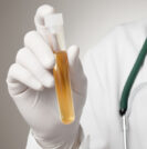 PCA3 urine test | Sperling Prostate Center