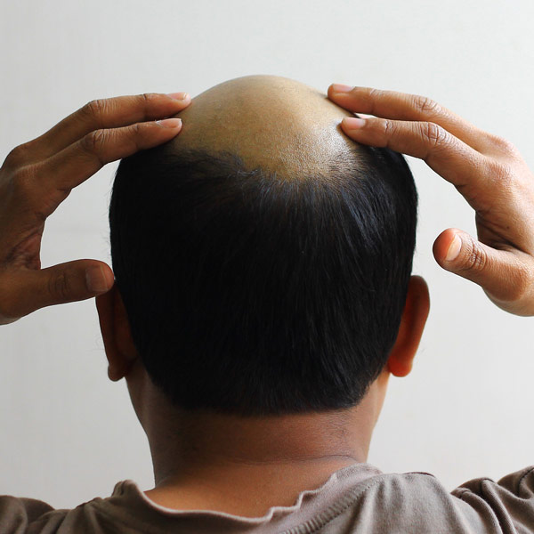 BPH, Balding, and Finasteride - Sperling Prostate Center - Sperling ...