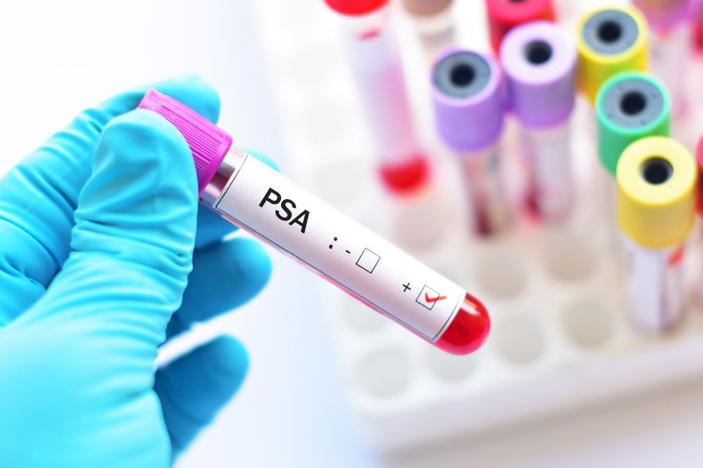 Psa Uk Get Your Annual PSA Blood Test! - Sperling Prostate Center
