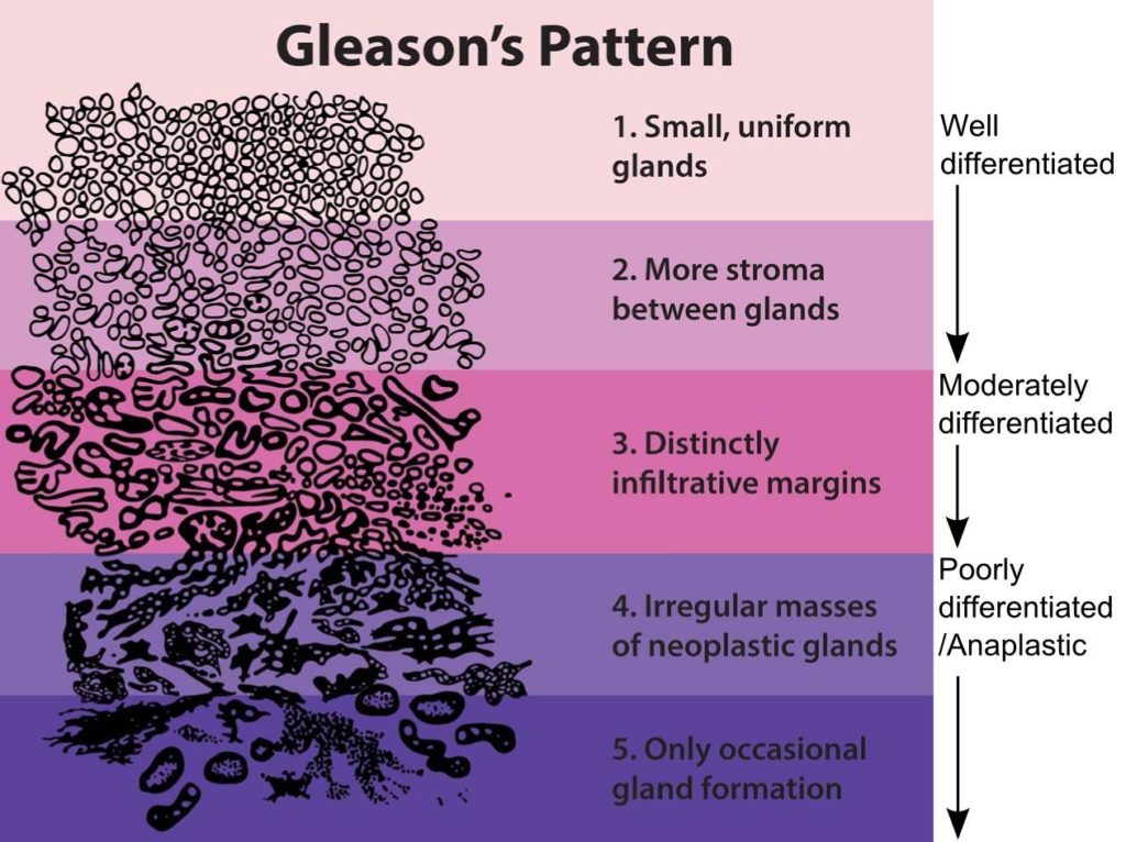 Gleason pattern - Sperling Prostate Center