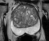 Prostate MRI