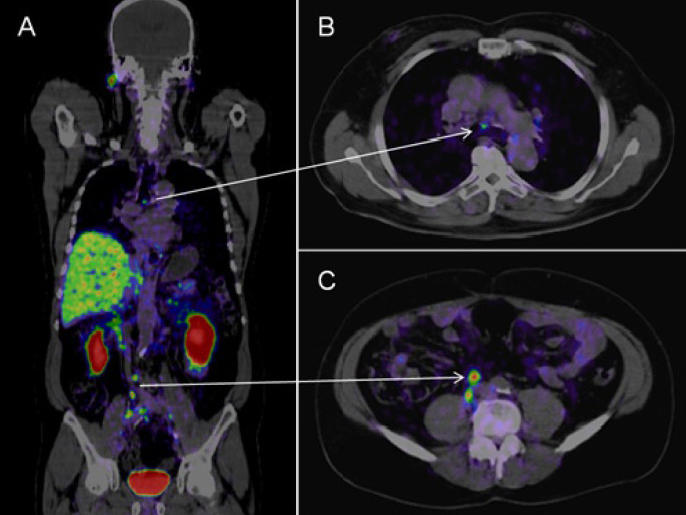 psma-pet-ct-sperling-prostate-center