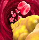 Cholesterol and prostate cancer
