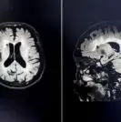 Brain MRI