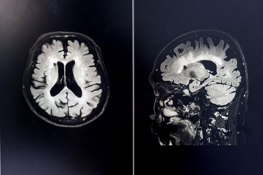 Brain MRI