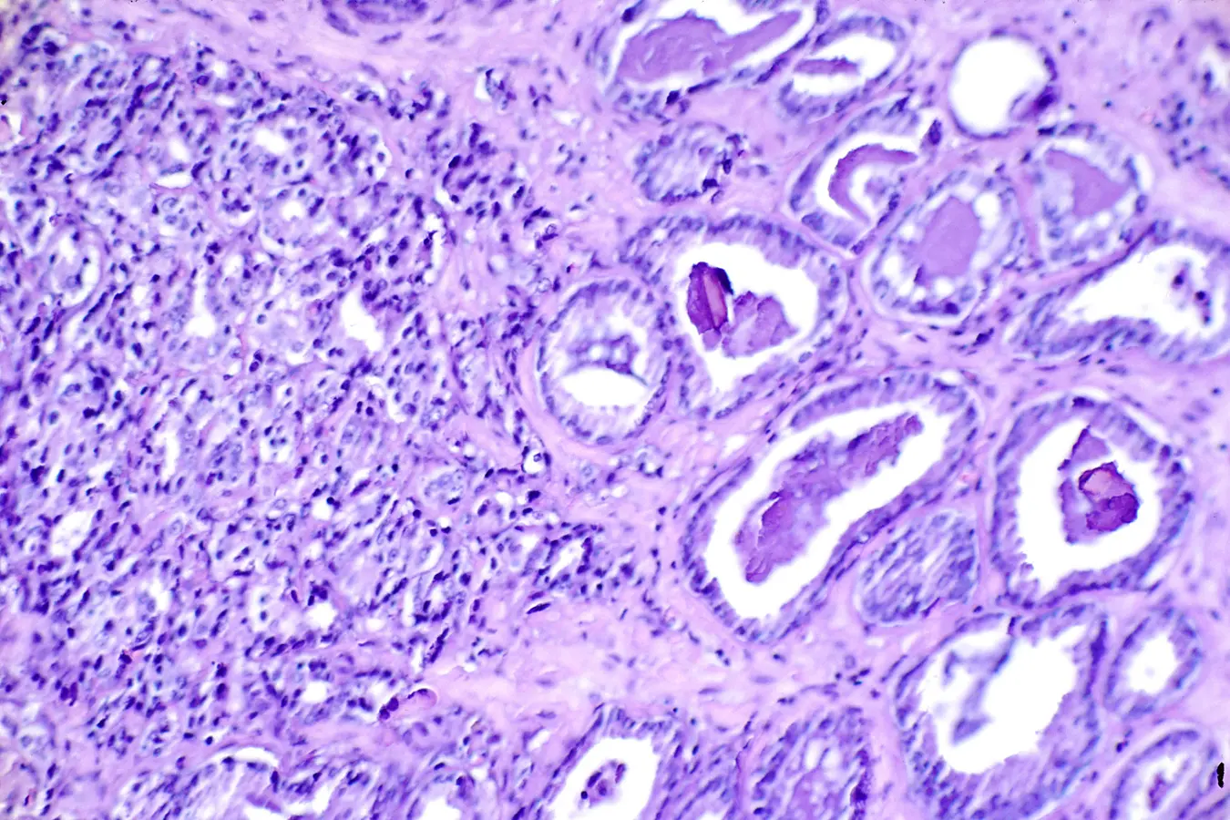 Histological slide (H & E stain at x300) showing prostate cancer. 