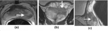 In images a, b, and c, arrows point to a tumor identified by mpMRI