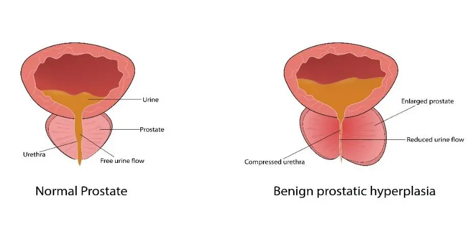 Diagram comparing a normal prostate versus a prostate exhibiting benign prostatic hyperplasia.