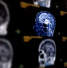 MRI shown using contrast agent