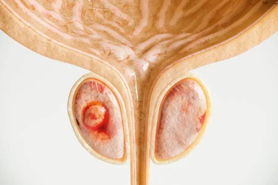 Illustration of prostate gland with tumor
