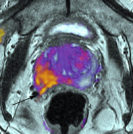 Prostate Cancer Screening - Sperling Prostate Center